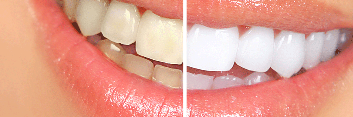 Dental Implants in Goregaon